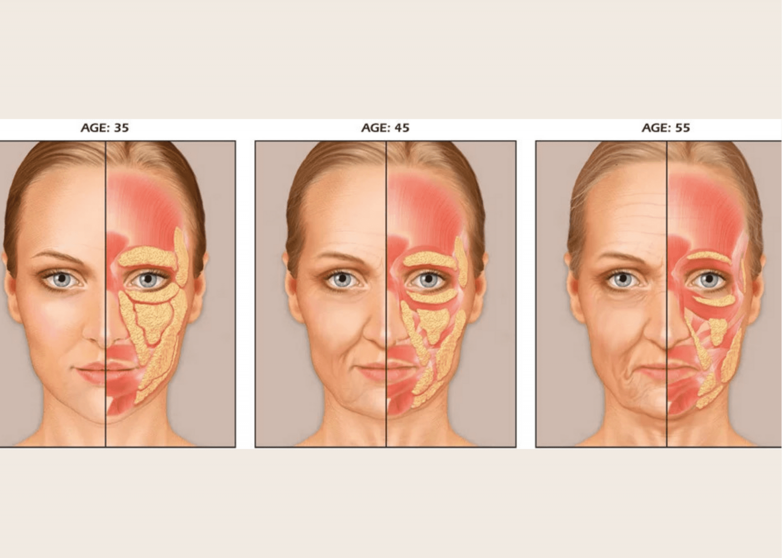 Жировые пакеты лица с возрастом. Возрастные изменения мышц лица. Жировые пакеты лица старение.